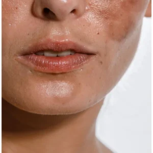 Tratamiento para Manchas